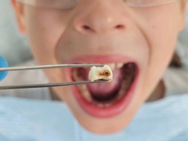 Dentist for Dental Trauma in GA